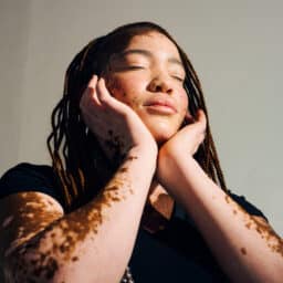 Woman with vitiligo holding her face