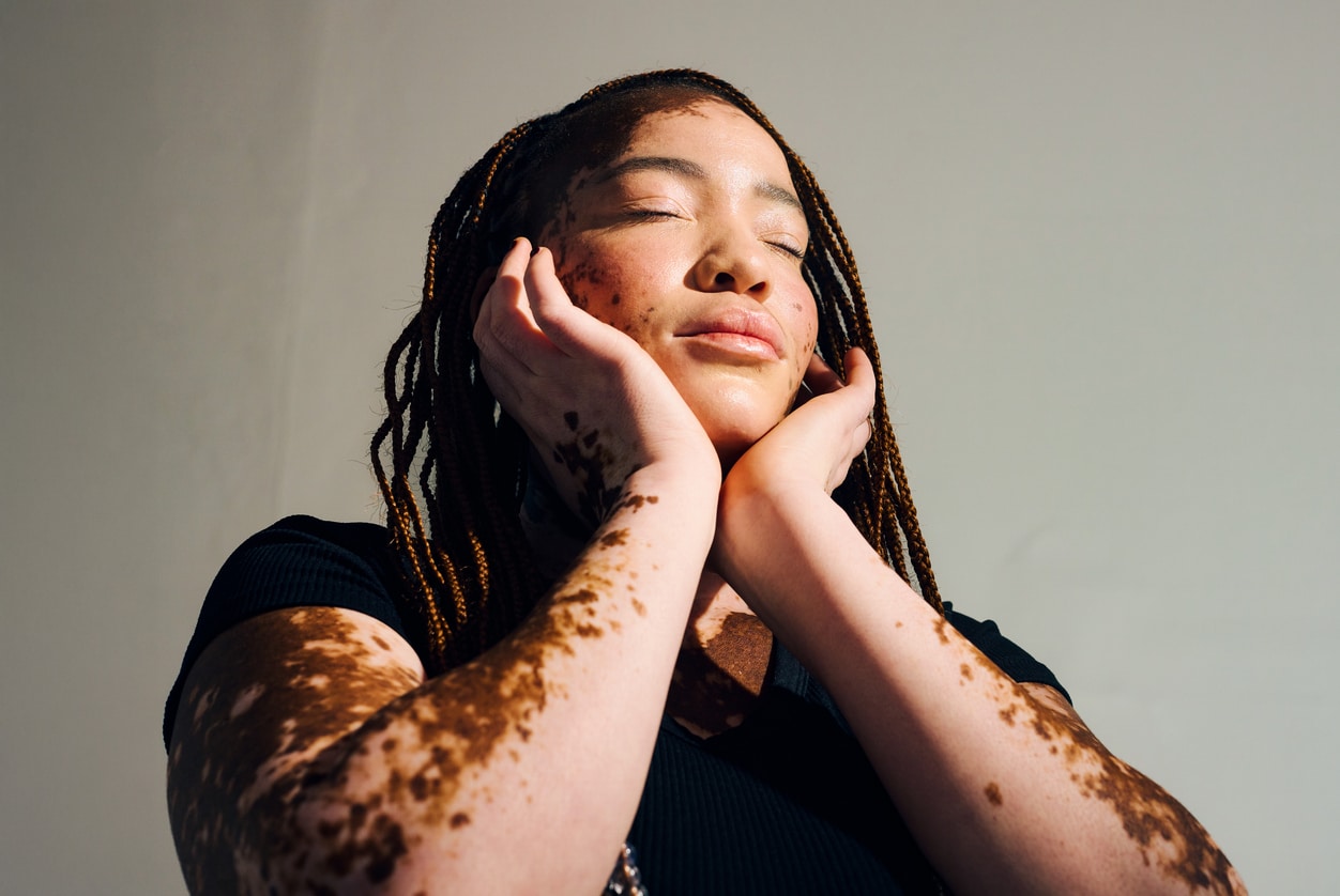 Woman with vitiligo holding her face.